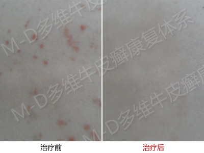 哪些原因导致了点滴型银屑病