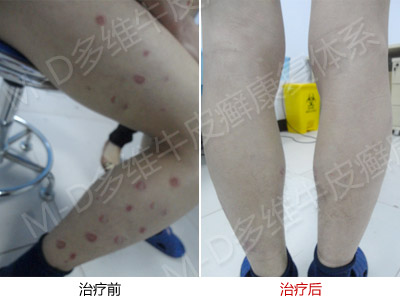 牛皮癣发病的症状特征是哪些