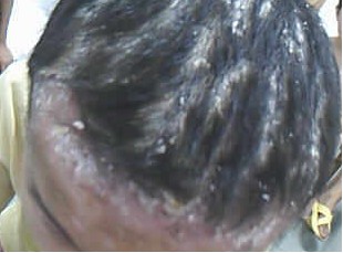 儿童患发银屑病都有哪些特征表现