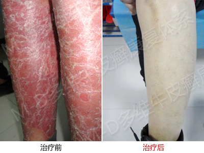 关于红皮型银屑病主要有什么常识