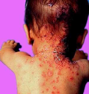 儿童患上脓疱型牛皮癣应该怎样护理