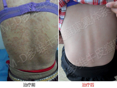 中医对牛皮癣分型治疗有什么方法呢