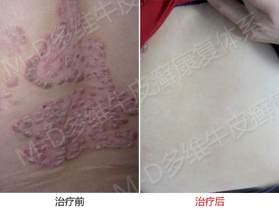 患有银屑病应该怎样治疗最好呢