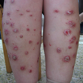 儿童水痘诱发牛皮癣的症状表现有什么
