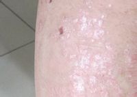泛发性脓疱型牛皮癣的有什么特点呢