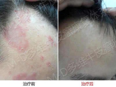 关于牛皮癣怎么辩证治疗好