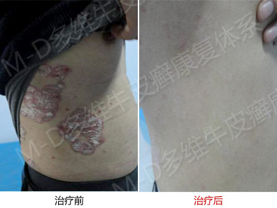 郑州市银屑病研究所能根治牛皮癣吗