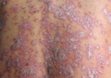 西安京科银屑病医学研究院在银屑病的治疗上好吗
