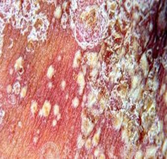 关于泛发性脓疱型银屑病有什么常识