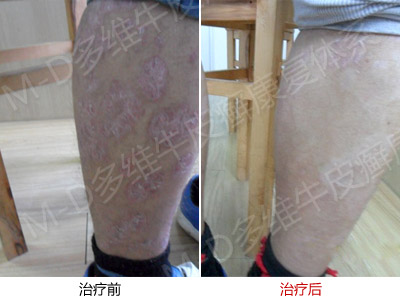 牛皮癣治疗的凉血解毒方药有哪些