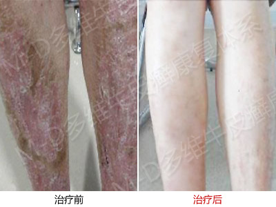 牛皮癣都有什么样的治疗方法