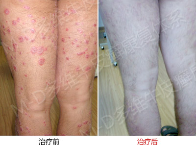 不及时治疗牛皮癣有什么危害