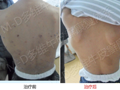 银屑病的相关治疗方式