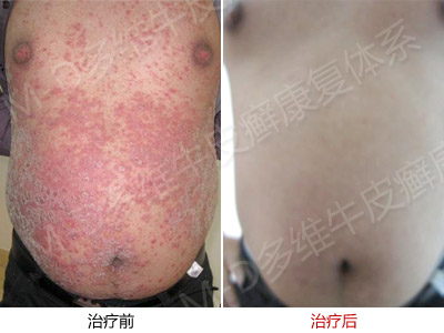 患者要正确认识银屑病不能被根治这一原理