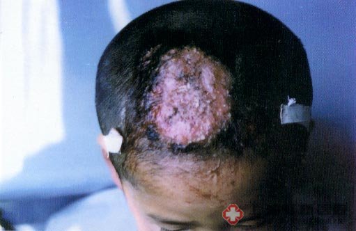 治疗婴儿牛皮癣应该如何做呢