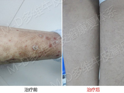 怎么治疗银屑病才更有效