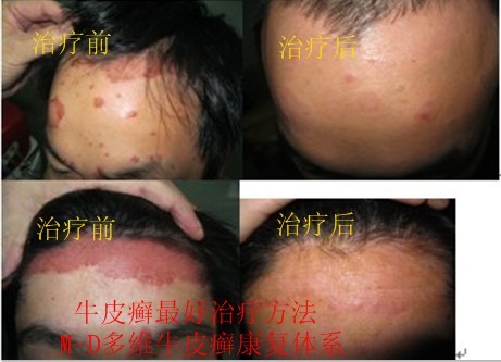 老年人脸部银屑怎么治疗呢