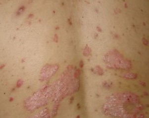 男性牜皮癣症状是什么