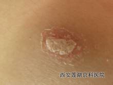青少年得了牛皮癣会有哪些症状