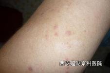 稳定期牛皮癣症状有哪些