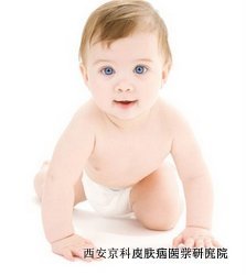 婴幼儿牛皮癣症状