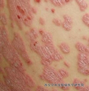 怎样治疗红皮病型银屑病