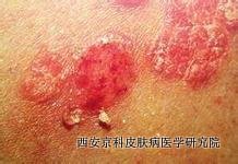 最常见的男性牛皮癣症状有哪些
